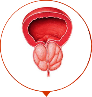 Ilustração de adenoma de próstata